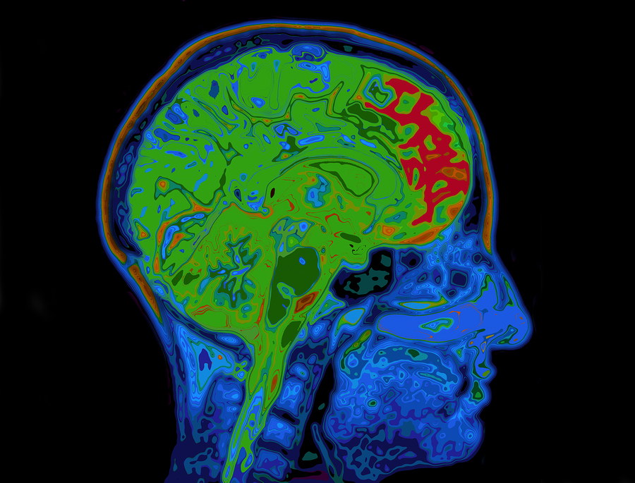 MRI Image Of Head Showing Colorized Brain